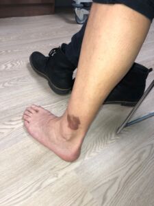 The mark on John's ankle which turned out to be sarcoma cancer