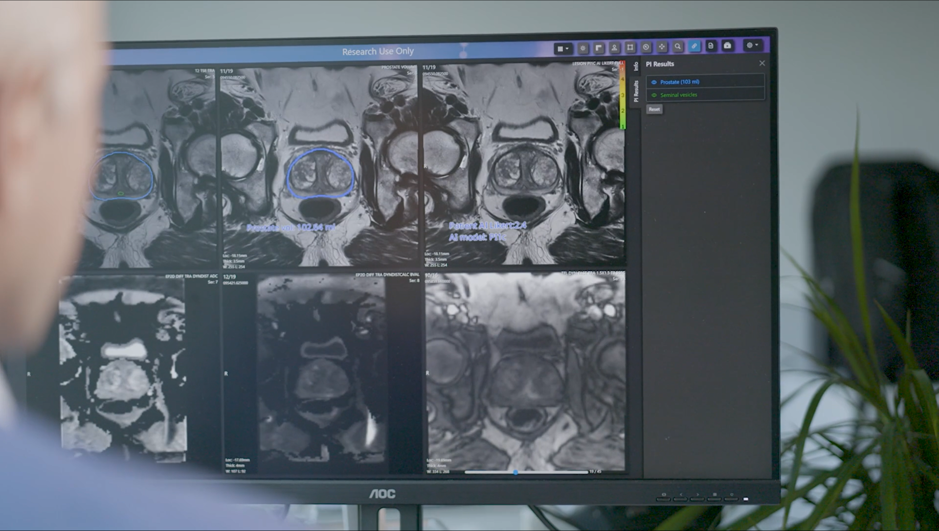 A person is observing a computer monitor displaying multiple MRI AI prostate scans